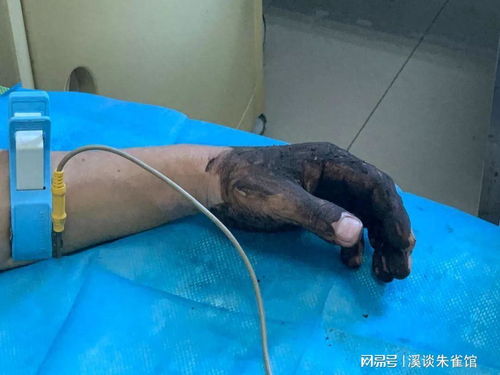 男子割草时被眼镜蛇咬伤手指险截肢